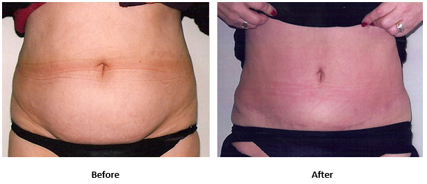 Comparison Between Liposuction and Tummy Tuck - AllureMedSpa