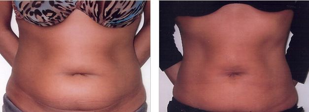 Before-and-after photo of a Toronto liposuction patient