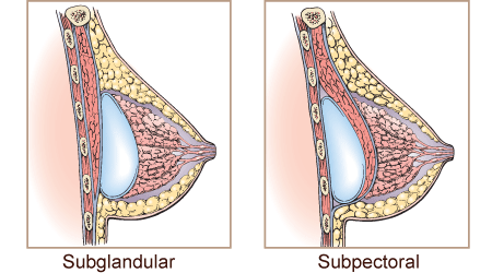 subglandular vs subpectoral diagram