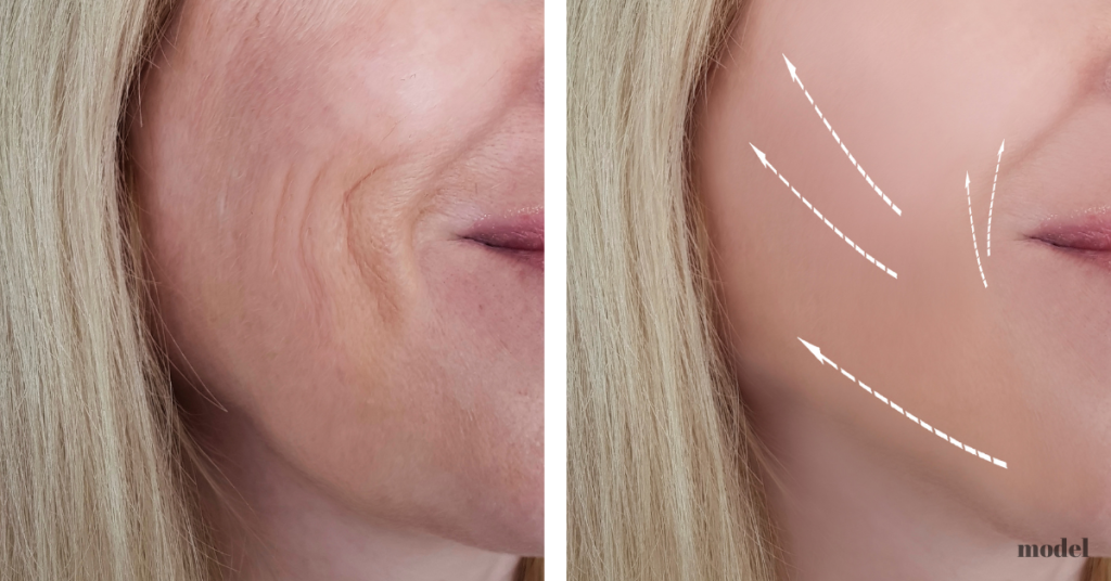 before and after of woman's skin after dermal fillers (model)