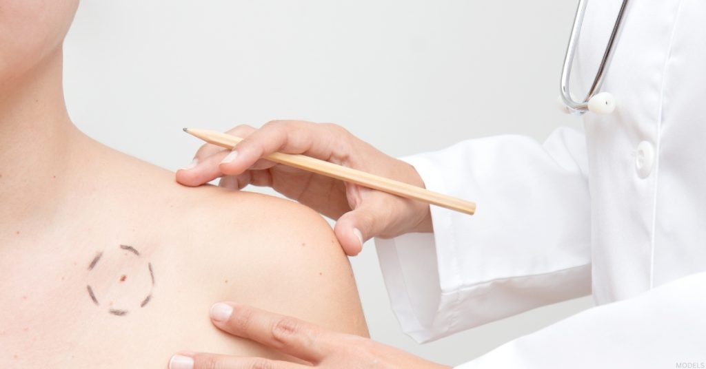 Doctor marking skin for skin cancer removal (models)