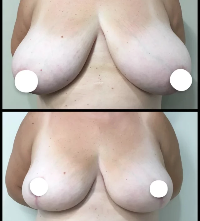 A lighter, more confident you.
This beautiful transformation comes from a bilateral breast reduction with liposuction. Not only does it create a more balanced, natural shape, but it also helps bring comfort and ease to everyday life. Our goal is always to enhance your confidence while keeping results soft, natural, and uniquely you. 💕