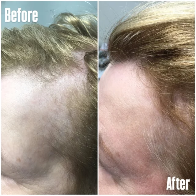 ✨From thinning to thriving!✨
PRP (Platelet-Rich Plasma) is your body’s own secret weapon for hair restoration — and these results speak for themselves. Using your own plasma, packed with powerful growth factors, we help stimulate dormant follicles, boost thickness, and bring life back to your hair naturally. No surgery, no downtime… just stronger, fuller, healthier hair.