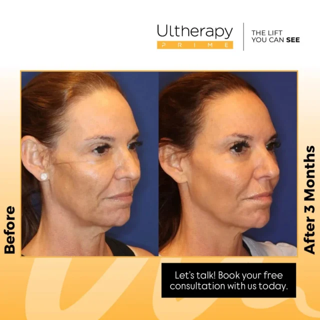 Ultherapy is best suited for individuals experiencing mild to moderate skin laxity who want a natural-looking lift without surgery or downtime. Ideal candidates typically notice sagging around the jawline, neck, chin, or brows and prefer a gradual tightening effect by stimulating their body’s own collagen production. It’s a great option for those who want to refresh and firm their appearance but are not ready for invasive procedures. 

☎️Call today to book your free consultation and find out if Ultherapy is right for you.