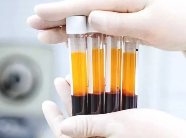 ✨ PRF vs PRP – What’s the Difference? ✨

Looking for a natural way to rejuvenate your skin and stimulate collagen? Two of the most popular regenerative treatments are PRP (Platelet-Rich Plasma) and PRF (Platelet-Rich Fibrin). Both use your body’s own healing power — but there are key differences.

💉 PRP – Platelet-Rich Plasma• Blood is spun at a higher speed to isolate platelets• Often combined with microneedling or injections• Helps stimulate collagen and improve skin texture• Great for overall skin rejuvenation

🌿 PRF – Platelet-Rich Fibrin• Spun at a lower speed with no additives or anticoagulants• Creates a fibrin matrix that releases growth factors more slowly• Contains more healing cells and stem cells• Ideal for delicate areas like under the eyes and for longer-lasting regenerative results

✨ The Result? Healthier, smoother, more radiant skin using your body’s own natural growth factors.

Not sure which treatment is right for you? Our team will customize the best option for your skin goals.

📞 905 273 3045 Book your consultation today and discover the power of regenerative aesthetics!

#PRF #PRP #SkinRejuvenation #NaturalBeauty #CollagenBoost MedicalAesthetics