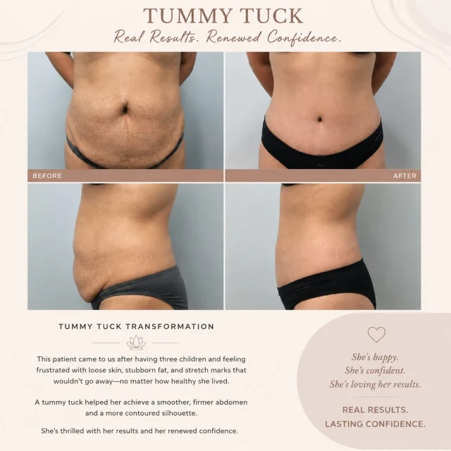 ✨ Tummy Tuck Transformation ✨

Every patient’s journey is unique, and we’re honored to help our patients achieve their aesthetic goals.

📞 Call us today at 905-273-3045 to book your complimentary consultation.

#TummyTuck #Abdominoplasty #RealResults #BeforeAndAfter #MommyMakeover PlasticSurgery MississaugaCosmeticSurgery BodyConfidence CosmeticSurgery TransformationJourney DrWeinberg MCSC